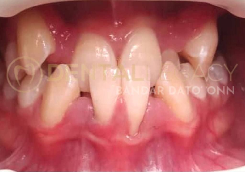 BRACES (ORTHODONTIC TREATMENT) Dental Clinic in Johor Bahru Klinik